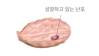 정상 난소 이미지