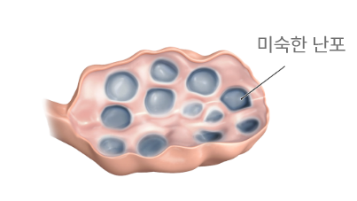 다낭성 난소 이미지